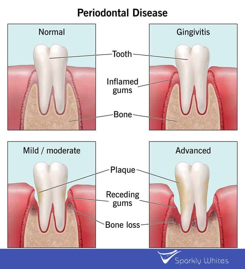 Can Gum Bleeding Really Indicate Poor Oral Hygiene Chichester?