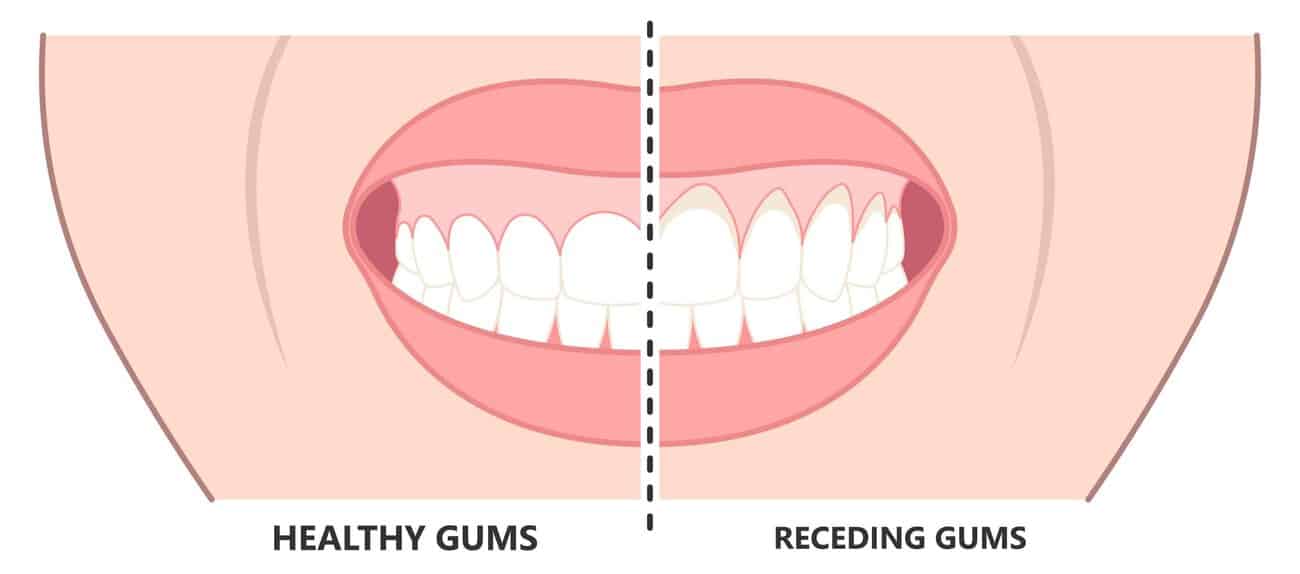 What Causes Gums to Recede Over Time Chichester